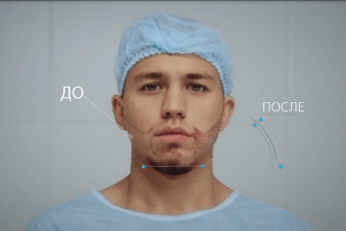 HFE: 15 лидов ежедневно для клиники пересадки волос